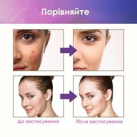 Лікувальний пластир від прищів 180 шт.